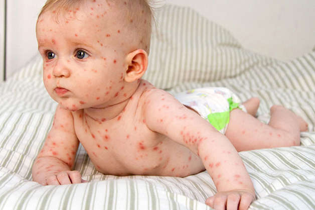 Sốt và nổi ban đỏ khắp người là dấu hiệu cho thấy trẻ bị sốt virus