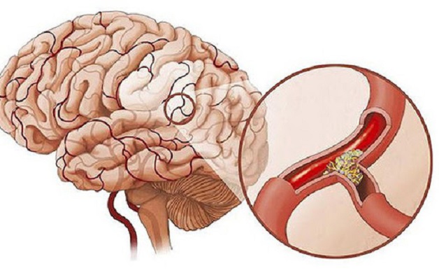 nguyên nhân gây rối loạn tiền đình trung ương-