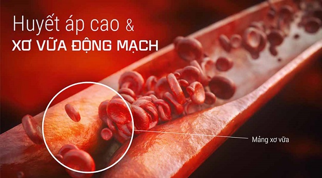 thiếu máu não dấu hiệu nhận biết