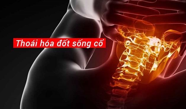 thoái hóa, thoát vị đĩa đệm cột sống cổ gây đau nửa đầu kéo dài.