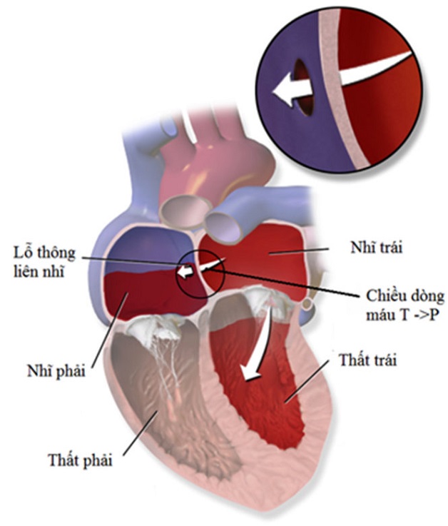 Thông liên nhĩ lỗ thứ hai là một trong 4 dạng của bệnh thông liên nhĩ - hiện tượng tồn tại lỗ thông giữa 2 tâm nhĩ