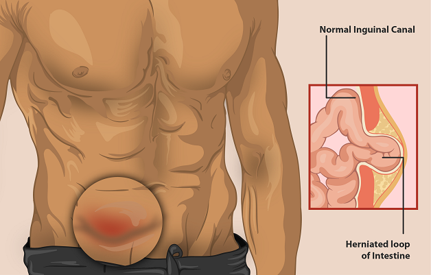 Tìm hiểu thoát vị bẹn triệu chứng