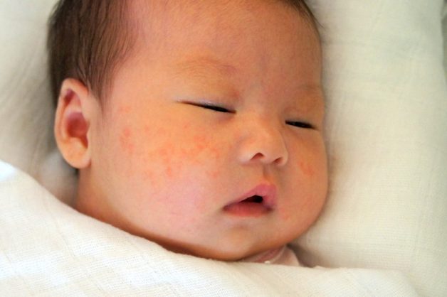 Trẻ bị sởi nếu không được điều trị kịp thời sẽ để lại những biến chứng nguy hiểm