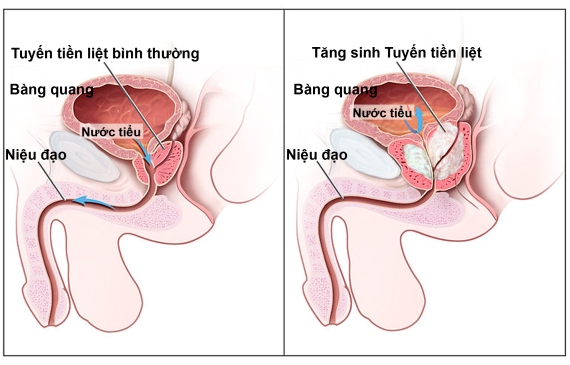 U xơ tuyến tiền liệt ở nam giới thường xuất hiện với những dấu hiệu về đường tiểu