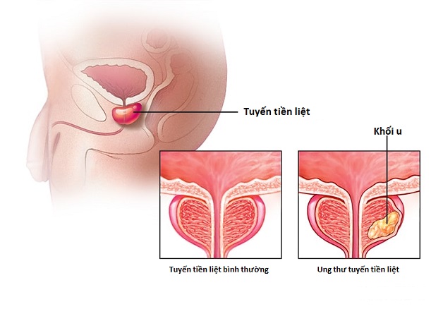 Ung thư tuyến tiền liệt ở nam giới