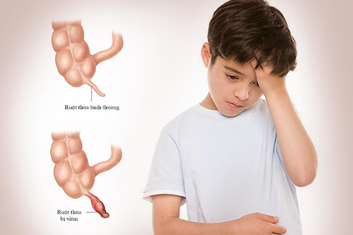 Nguyên nhân đau ruột thừa ở trẻ em