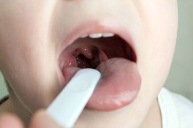 Viêm amidan là gì, cách trị viêm amidan cho trẻ như thế nào cho hiệu quả là thắc mắc của nhiều cha mẹ khi có con em bị bệnh viêm amidan.