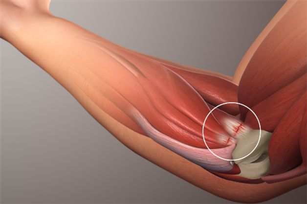 viêm khớp khuỷu tay là gì