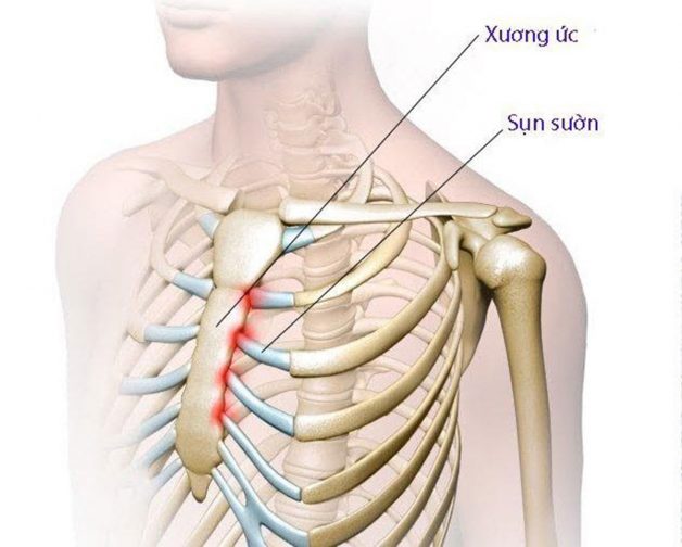 Hiểu về vị trí sụn sườn và chứng viêm nhiễm