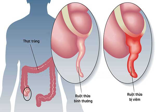 Viêm ruột thừa cấp rất nguy hiểm vì có thể bị vỡ ruột thừa