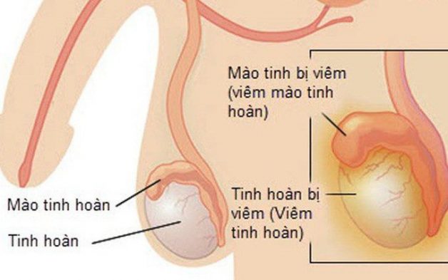 Viêm tinh hoàn là căn bệnh thường gặp ở nam giới
