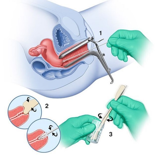 Xét nghiệm tế bào ung thư cổ tử cung pap smear