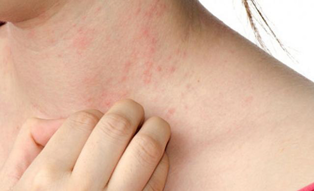Nổi mề đay cũng là dấu hiệu của xơ gan độ 1