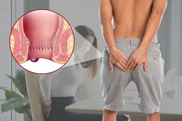 Trĩ ngoại nhẹ là gì?