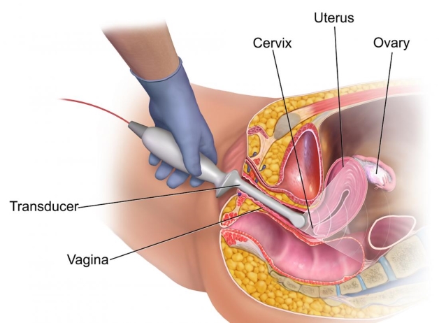 Siêu âm đầu dò âm đạo khi bị tắc vòi trứng
