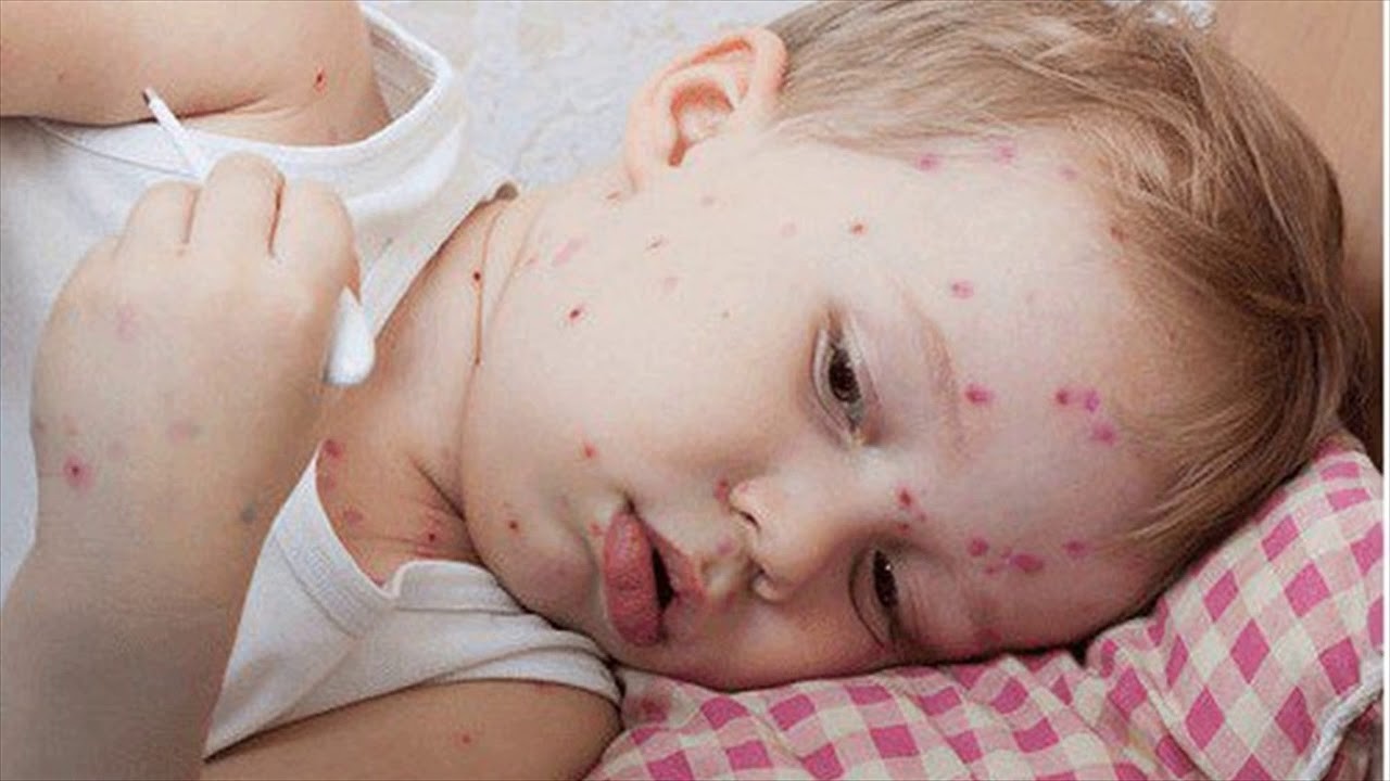 Mặt đỏ, da ửng hồng; có thể xuất hiện ban đỏ trên thân mình là dấu hiệu điển hình của sốt xuất huyết