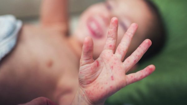 Ở mỗi giai đoạn khi bé bị tay chân miệng thì sẽ có những triệu chứng khác nhau