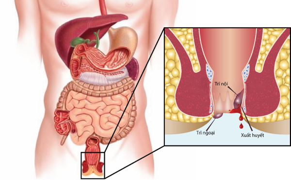 Trĩ ngoại nhẹ là gì?