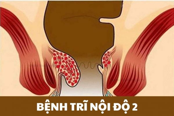 Trĩ nội độ 2 là gì
