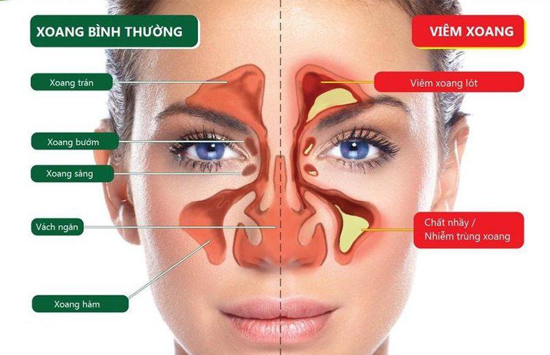 Hình ảnh xoang bình thường và xoang bị viêm