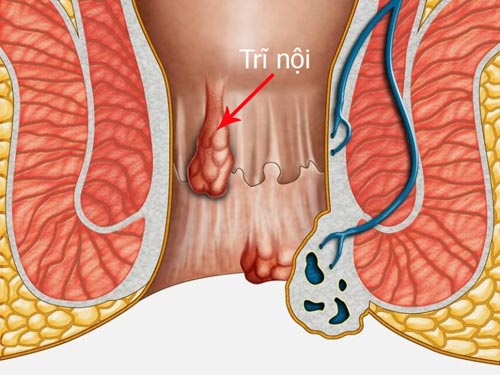 Cách điều trị trĩ nội phụ thuộc mức độ trĩ