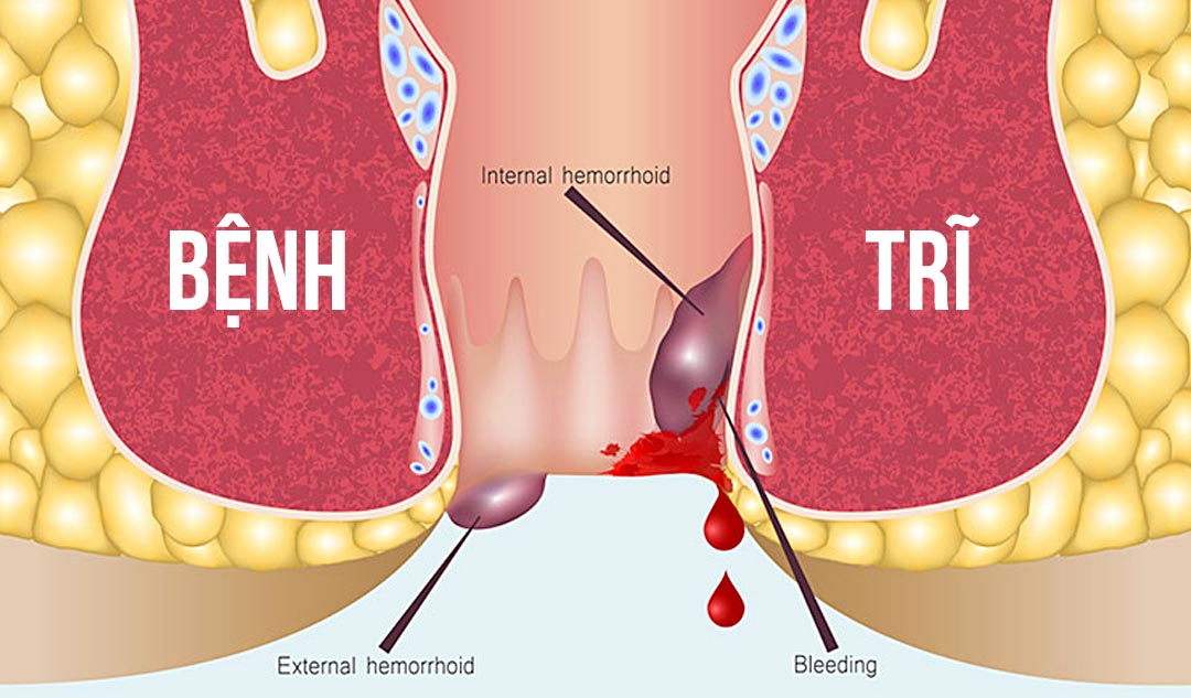 Cắt trĩ bằng phương pháp Longo là gì
