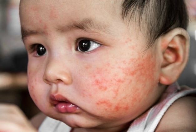 trẻ 7 tháng bị nổi mẩn đỏ khắp người