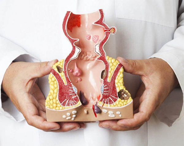 Biến chứng phẫu thuật trĩ ngoại
