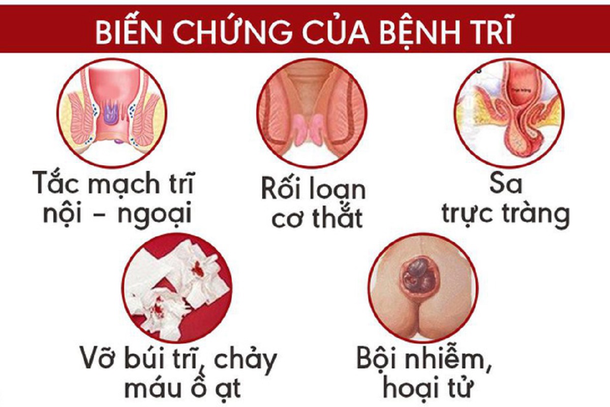 Chữa trị bệnh trĩ hiệu quả