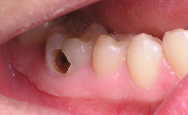Chụp sứ răng hàm là phương pháp thẩm mỹ áp dụng được cho nhiều khuyết điểm của răng