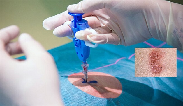 Dấu hiệu ung thư hắc tố và sinh thiết da