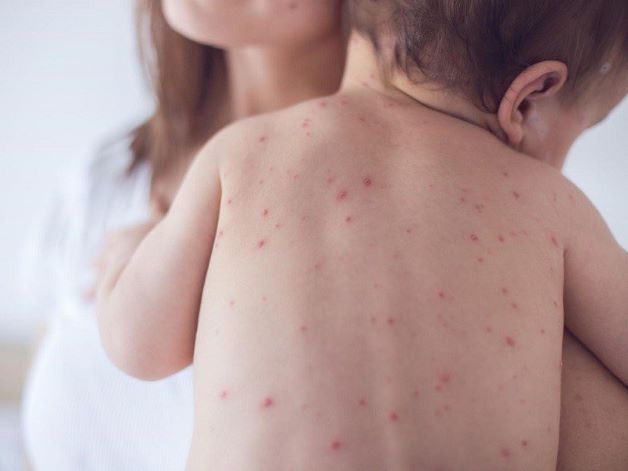 Do đó, trong quá trình mang thai, nếu người mẹ mắc thủy đậu nhưng không được chữa trị dứt điểm thì trẻ sơ sinh khi sinh ra sẽ có nguy cơ nhiễm bệnh thủy đậu là rất cao.