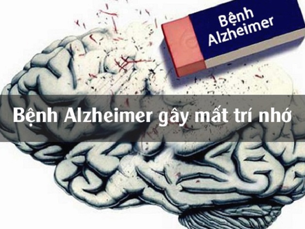 điều trị suy giảm trí nhớ do bệnh alzheimer gây ra