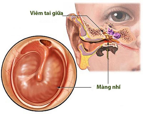 Viêm tai giữa là sự tổn thương và viêm nhiễm xuất hiện trong tai giữa do các loại virus, vi khuẩn sinh sôi ở tai hoặc các yếu tố bên ngoài môi trường tác động. 