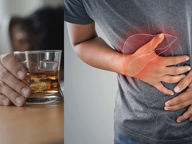 Gan nhiễm mỡ độ 2 kiêng gì - Rượu bia