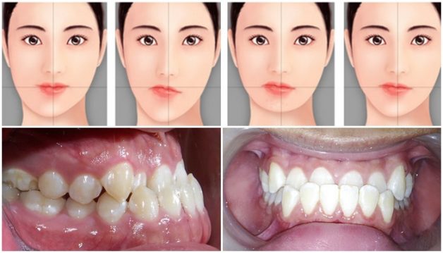 Hàm lệch là hiện tượng xương hàm bị đưa ra phía trước quá nhiều, lùi về sau quá mức hoặc lệch hẳn sang một bê