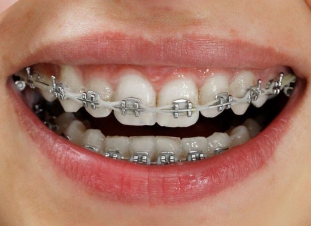 Niềng răng bằng mắc cài kim loại