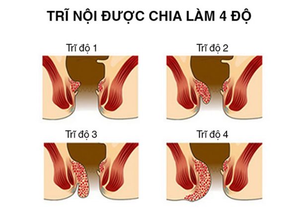 Trĩ nội độ 2 là gì