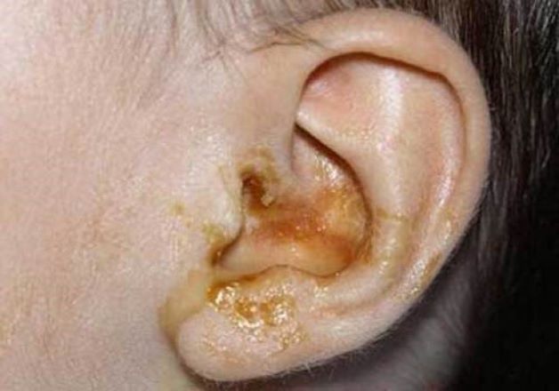 Ống tai ngoài của trẻ có dịch hoặc mủ chảy ra. Đây là dấu hiệu nguy hiểm cho thấy màng nhĩ của trẻ đã bị vỡ do áp lực quá mức.