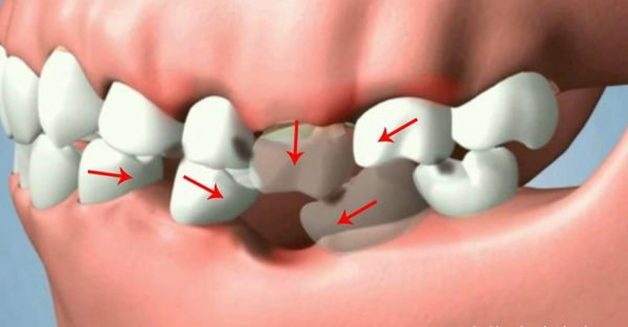 Mất răng gây ra nhiều hậu quả nghiêm trọng ảnh hưởng đến sức khỏe răng miệng cũng như sức khỏe tổng thể