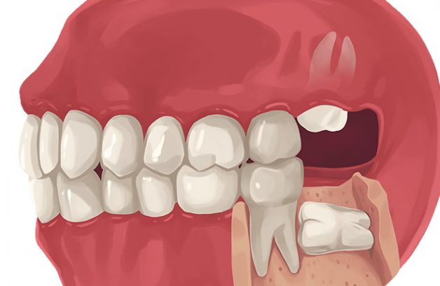 Răng khôn không có tác dụng gì trên cung hàm, thậm chí còn gây hại cho những răng lân cận