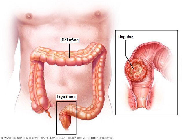 Hình ảnh ung thư đại trực tràng