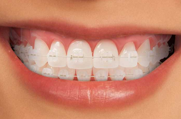 Chất liệu sứ của niềng răng mắc cài sứ có màu sắc tự nhiên như răng thật và đỡ bị lộ khi giao tiếp