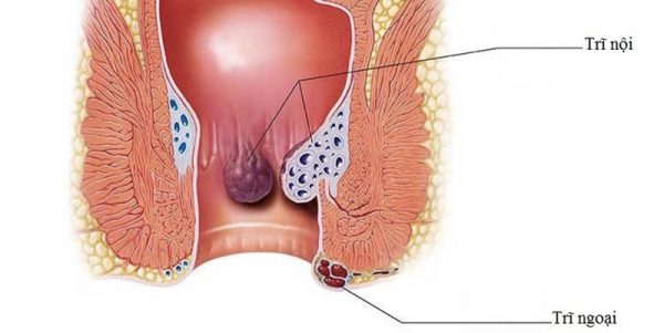 Bệnh trĩ và phân loại trĩ