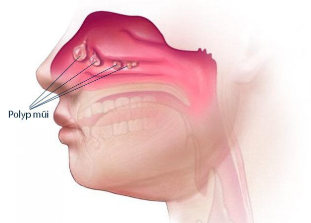 Khi bệnh nhân có polyp mũi, bác sĩ sẽ chỉ định thực hiện mổ nội soi mũi xoang