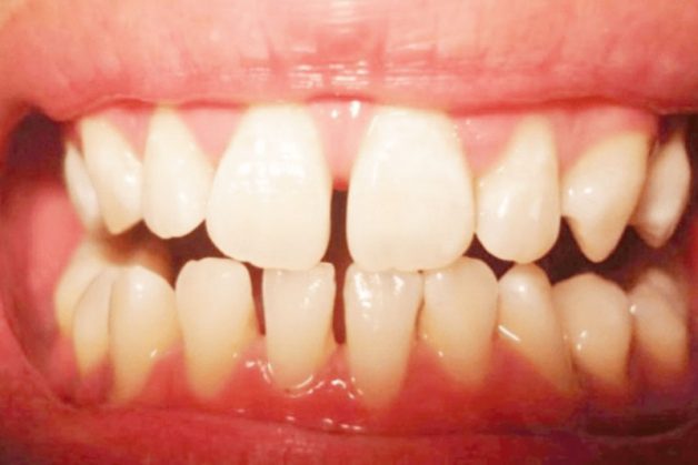 Răng thưa là một trong những trường hợp có thể niềng răng