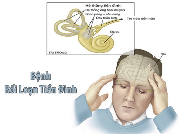 rối loạn tiền đình