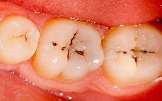 Răng sâu là một bệnh lý răng miệng phổ biến trên thế giới, bị hầu hết ở mọi đối tượng kể cả trẻ sơ sin