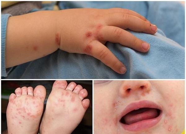 Tay chân miệng là bệnh lý truyền nhiễm gây ra bởi nhiều chủng virus khác nhau, trong đó, chủng tiêu biểu nhất có thể kể đến virus coxsackievirus A1