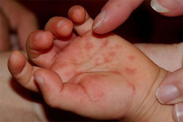 Nếu như trẻ bị tay chân miệng nhưng không sốt, bố mẹ có thể kiểm tra các dấu hiệu khác như lòng bàn tay, lòng bàn chân, đầu gối, mông có vết loét hoặc phát ban không